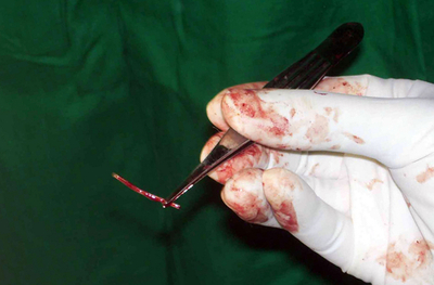 「熱した釘を打ち込まれた」、メイドの体から釘19本摘出