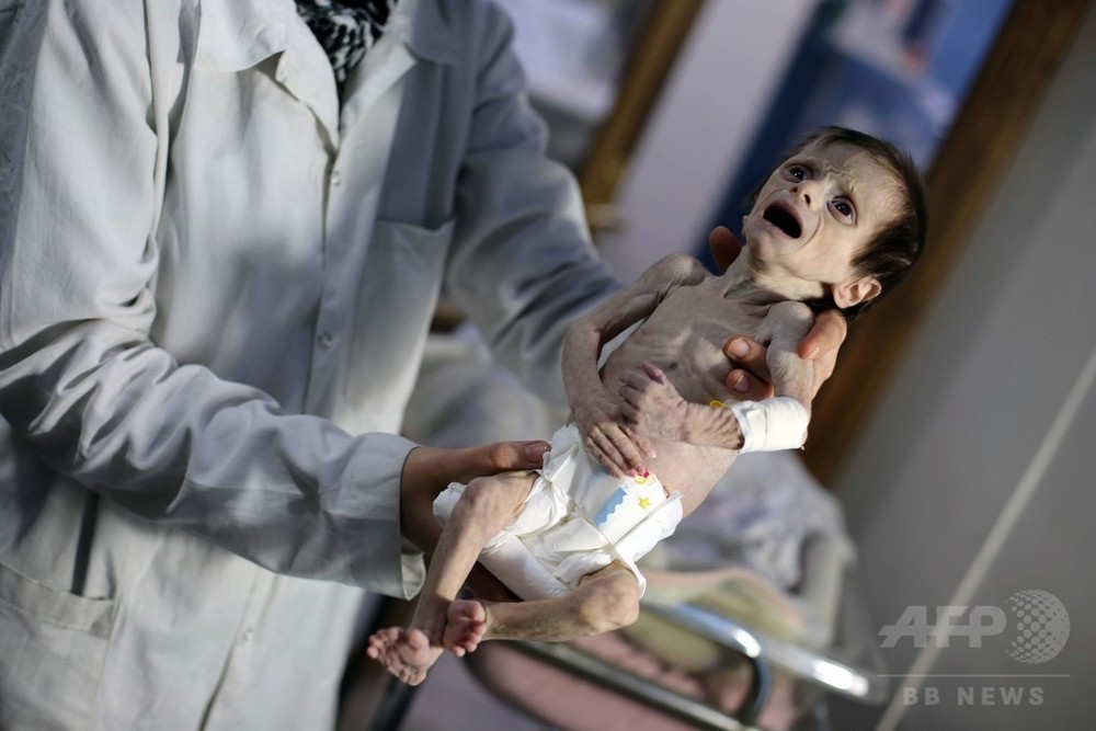 シリアの封鎖地域で 餓死する子どもたち 写真3枚 国際ニュース Afpbb News