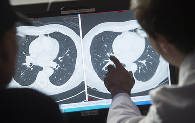 結腸がん検診は45歳から、米国がん協会が勧告 若い世代で発症増