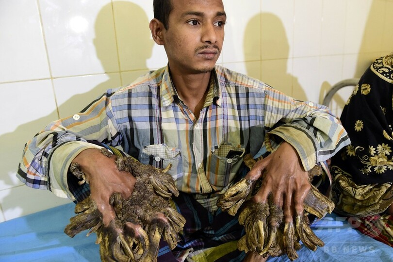 バングラデシュの「樹木男」 巨大イボ除去手術へ