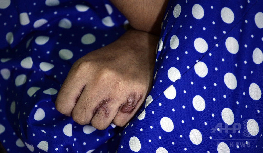 レイプと4度の酸攻撃に遭った女性、再び酸浴びせられる インド レイプと4度の酸攻撃に遭った女性、再び酸浴びせられる インド