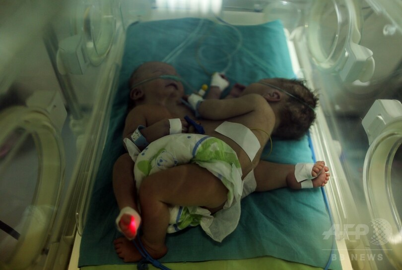 ガザ地区で結合双生児誕生、医師や親族が外国での分離手術訴え