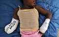 ハイチの首都ポルトープランス（Port-au-Prince）の総合病院で、大地震で手を失くし手当てを受けた少女（2010年1月23日撮影）。(c)AFP/Jewel SAMAD