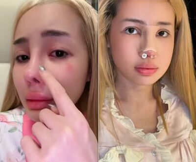 韓国で整形手術「鼻が歪んだ」痛々しいショット…ベトナム人気DJ、感染症で涙