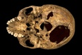 英レスター大学（University of Leicester）が公開した、15世紀のイングランド王リチャード3世（Richard III）の頭蓋骨。致命傷となったと考えられる2つの損傷跡（撮影日不明、2013年2月4日公開）。(c)AFP/HO/UNIVERSITY OF LEICESTER