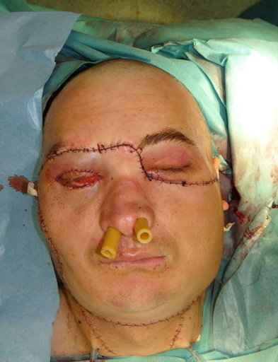 「世界初の救命顔面移植」にポーランドの医師らが成功