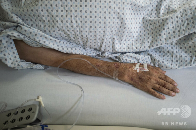 103歳女性、新型コロナから回復 メキシコ