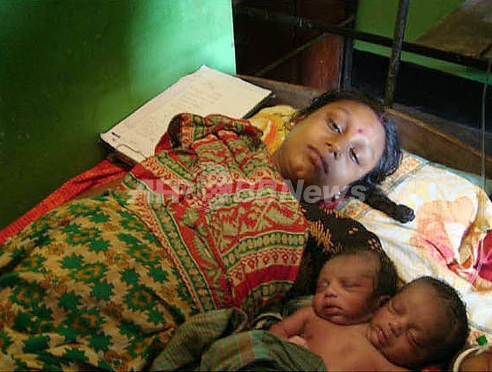 頭部が2つある赤ちゃんが死亡 バングラデシュ 写真1枚 国際ニュース Afpbb News