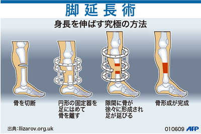 【図解】身長を伸ばす究極の方法「脚延長術」