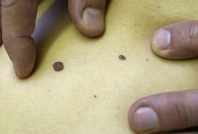 AI、ディープラーニングで医師より正確に皮膚がん発見 研究