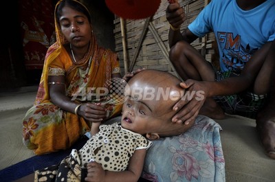 水頭症女児に病院が救いの手 Afpの写真がきっかけ インド 写真3枚 国際ニュース Afpbb News 水頭症女児に病院が救いの手 Afpの写真がきっかけ インド 写真3枚 国際ニュース Afpbb News
