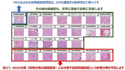 【横浜市立大学】国際標準をめざした腎癌診断支援法を開発