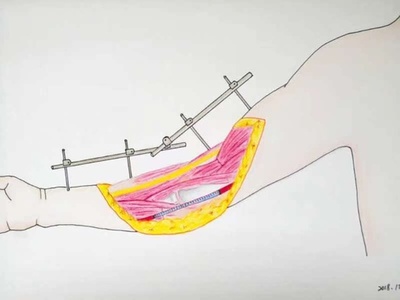 中国の外科女医 手書きのイラストで病状を説明