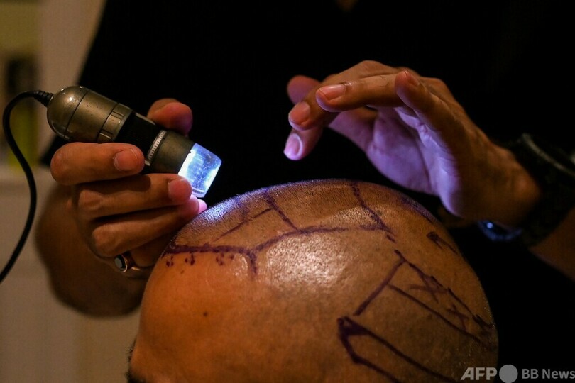 植毛手術後に死亡、YouTubeで独学の素人施術が横行 インド