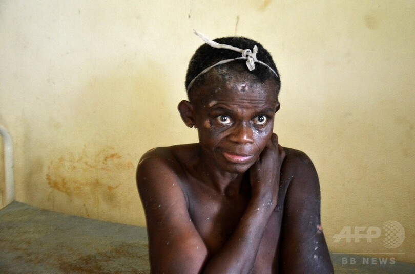 ガボン唯一の精神科病院、患者を「動物扱い」