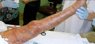 猛毒クラゲに両足を刺された少女、奇跡の生還 オーストラリア