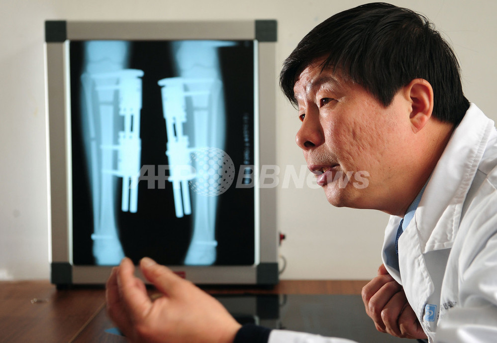 身長高くする 脚延長術 の第一人者 上海の医師 写真10枚 国際ニュース Afpbb News