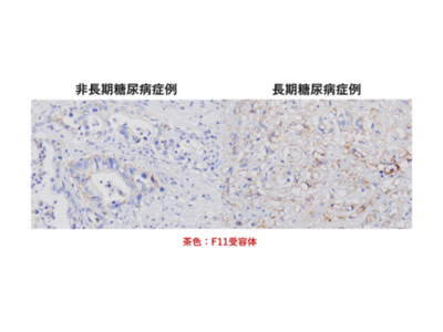 弘前大学の水上浩哉教授らの研究グループが長期糖尿病合併膵導管がんの新規発症機序を解明 ― MEG3、F11Rを標的とした新たな治療法の確立に期待