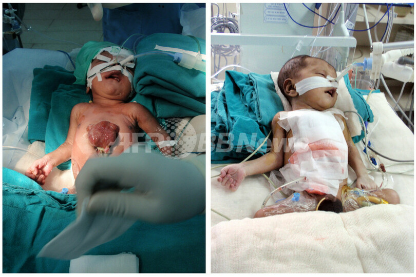 心臓逸脱症の赤ちゃん、心臓埋め込み手術に成功 インド