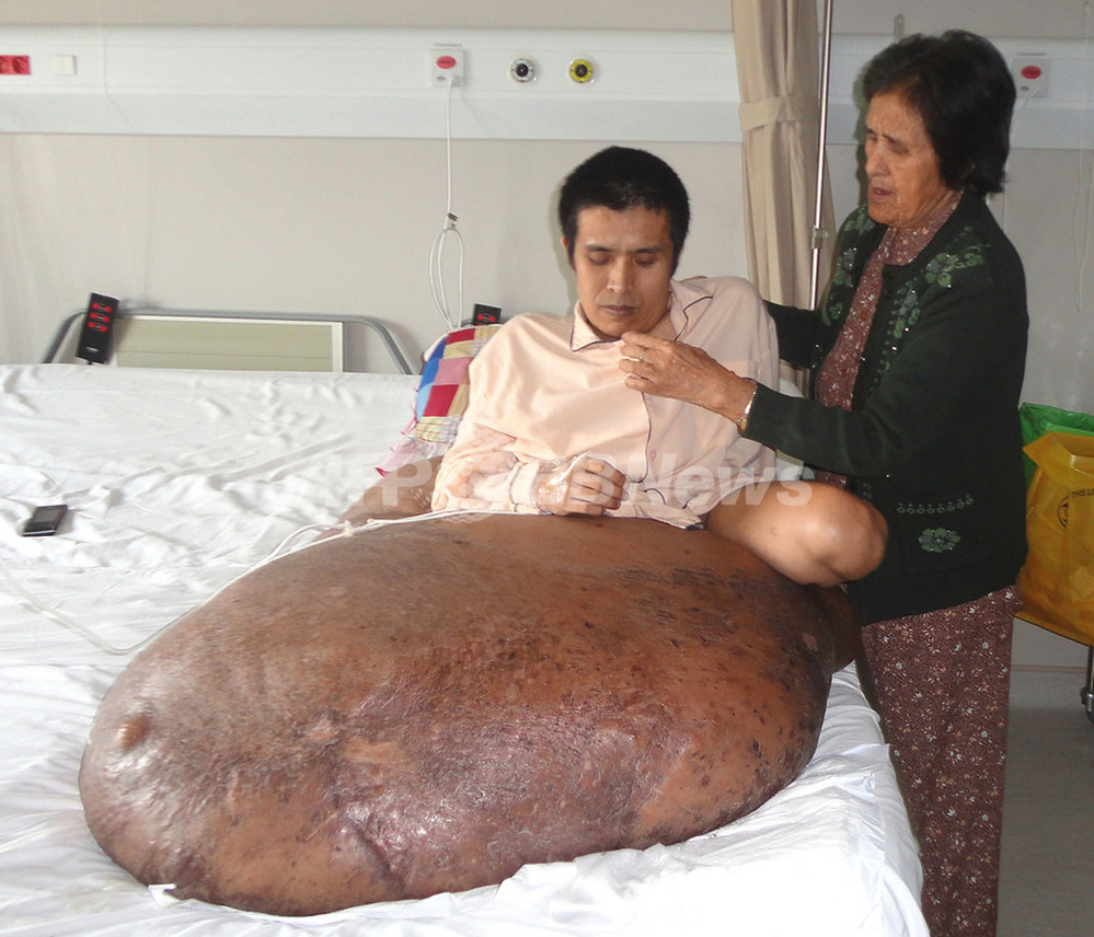 90キロの腫瘍ができたベトナム人男性、切除手術に臨む 写真2枚 国際ニュース：AFPBB News