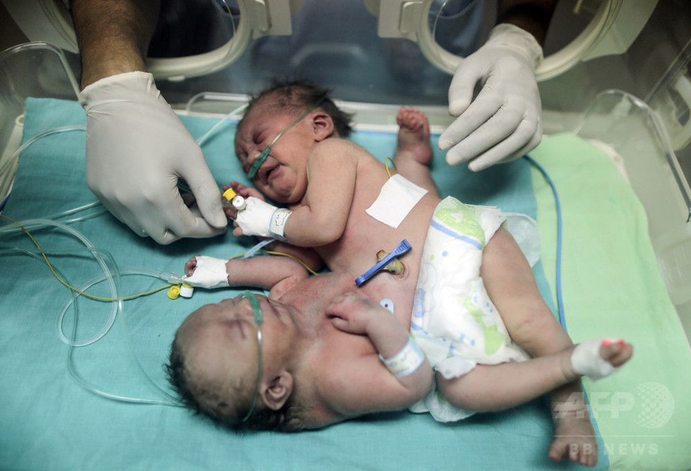 分離手術受けたガザの結合双生児 1人は死亡 サウジアラビア 写真1枚 国際ニュース Afpbb News