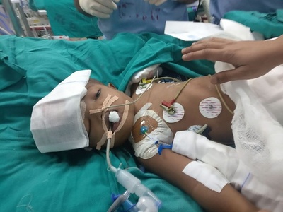 頭蓋骨結合の双生児、36時間超の分離手術が無事成功 インド
