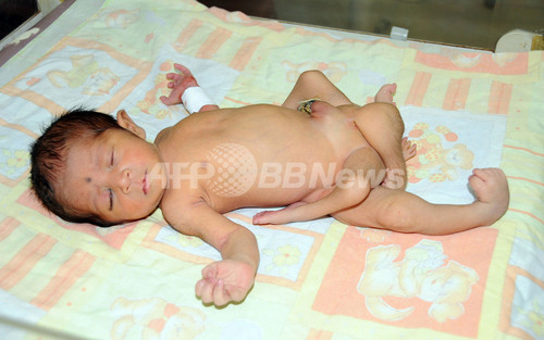 パキスタンで脚が6本ある赤ちゃん生まれる 写真3枚 ファッション ニュースならmode Press Powered By Afpbb News