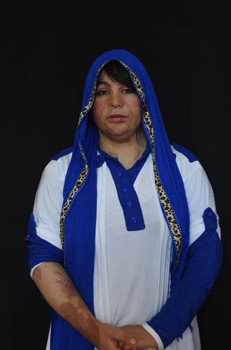 酸攻撃の被害女性つけ回す殺害脅迫、アフガニスタン