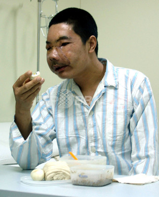顔面移植手術を受けた中国人男性 今年7月に死亡 写真3枚 ファッション ニュースならmode Press Powered By Afpbb News