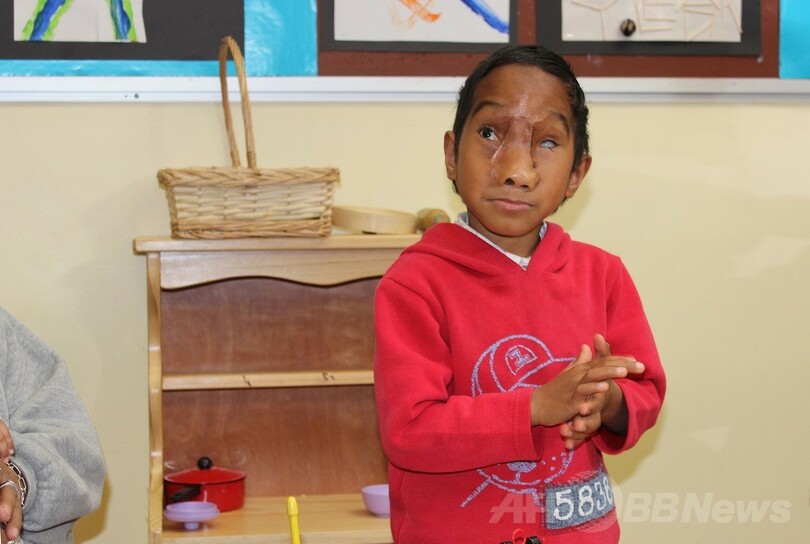 少年の顔から巨大ヘルニア嚢を除去、オーストラリア