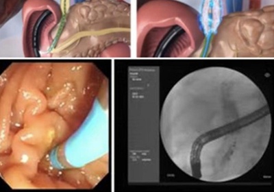 世界初の内視鏡下パルス電場腫瘍摘除術 中国・西安で実施に成功