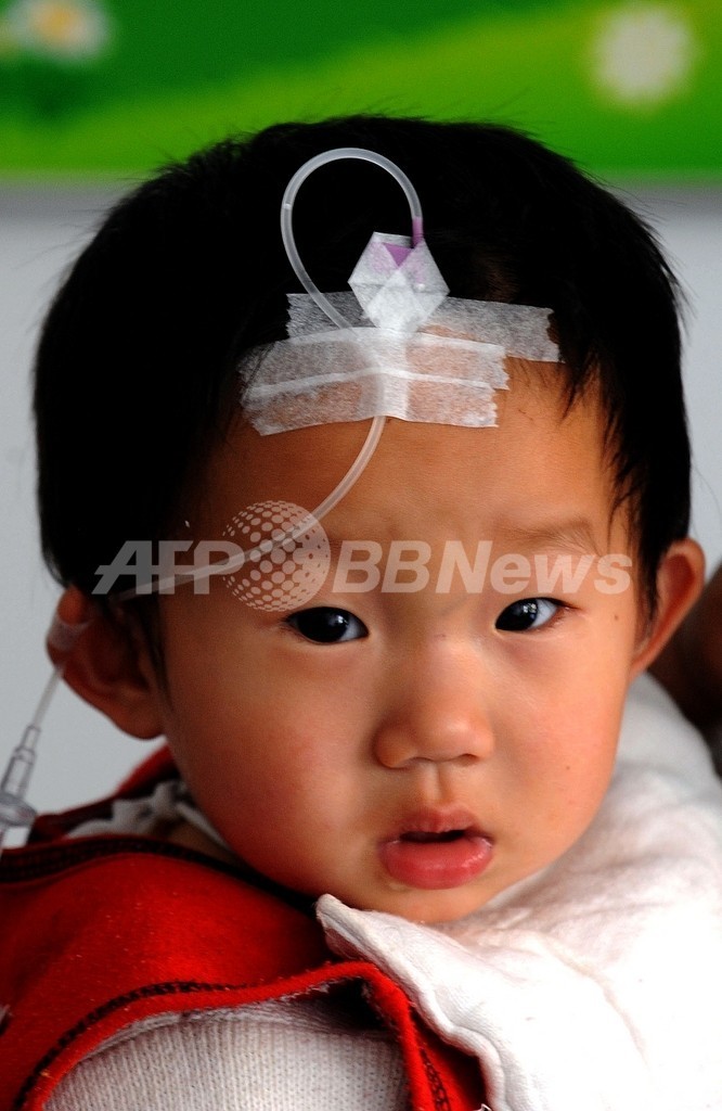中国の手足口病、発症8531人に 新華社 中国の手足口病、発症8531人に 新華社