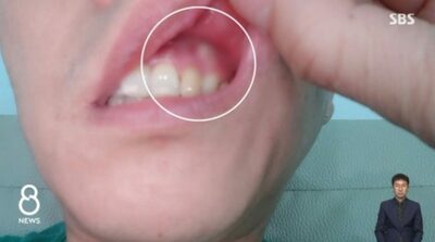 韓国・大学病院で歯を手術、でも痛みが取れない…50日後、歯茎から出てきた「腐ったガーゼ」