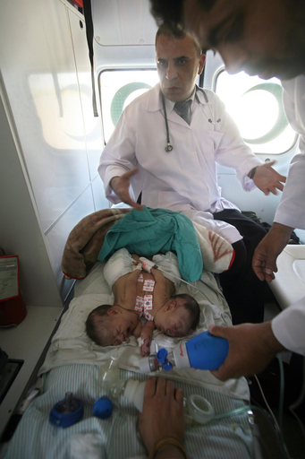 ガザの結合双生児が死亡