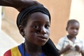 ニジェールのジンデルに設置されたスイスのNGO「サンティネル」の診療所で、壊疽性口内炎（水がん）の治療を受ける少女（2015年5月26日撮影）。(c)AFP/ISSOUF SANOGO