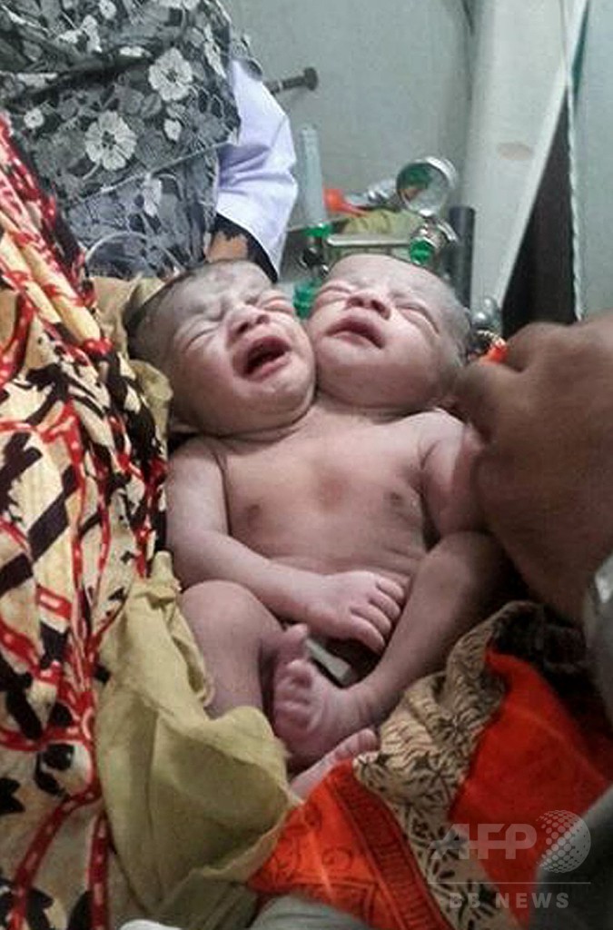 バングラデシュの結合双生児が死亡 写真1枚 国際ニュース Afpbb News