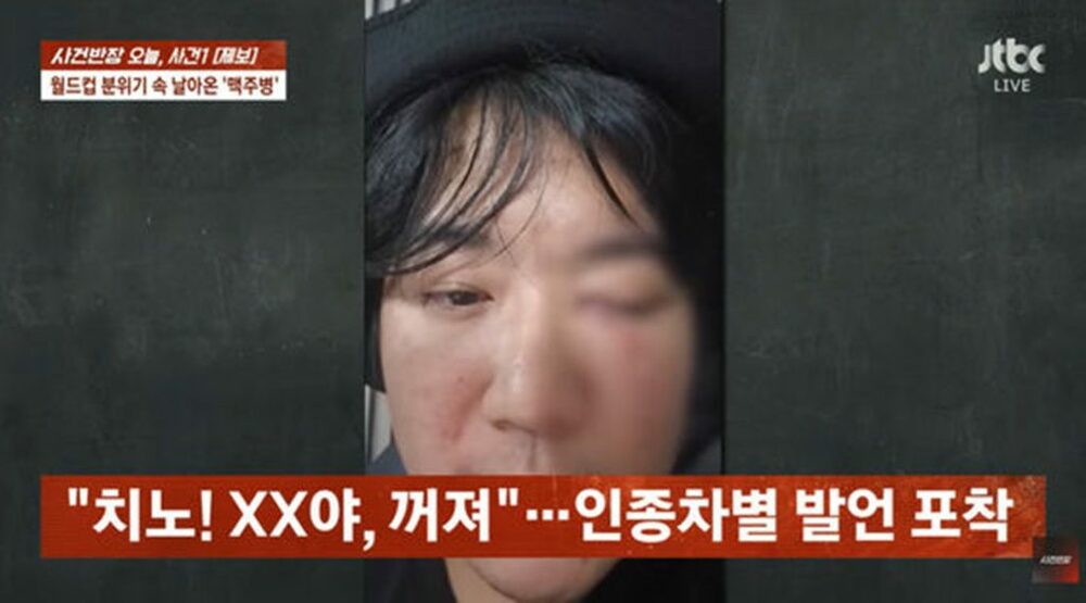 韓国人男性、メキシコで「人種差別的」暴行…ビール瓶が右目直撃、失明の危機