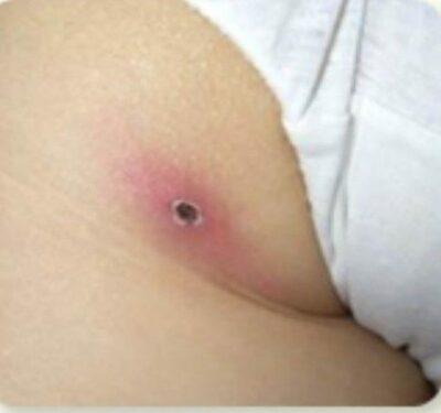 韓国で増える「ツツガムシ病」患者…2週間で5倍以上、特徴は「黒いかさぶた」