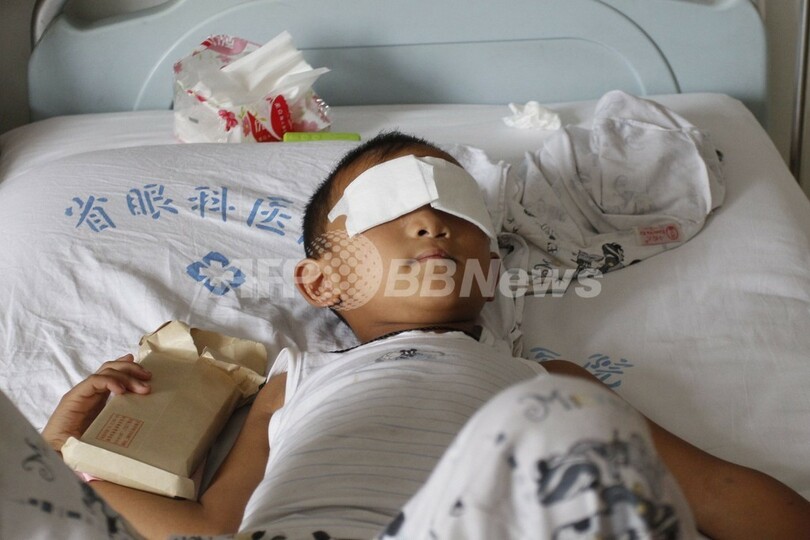 両目くりぬかれた男児、視力回復の可能性 眼科医が義眼無料移植申し出