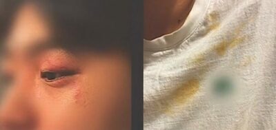 猿のような声で接近、押し倒され、目にスプレー…イタリアで韓国人観光客4人、襲われる