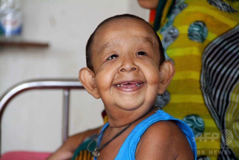 4歳児が老人に バングラデシュの奇病 医師らが原因究明へ 写真3枚 国際ニュース Afpbb News