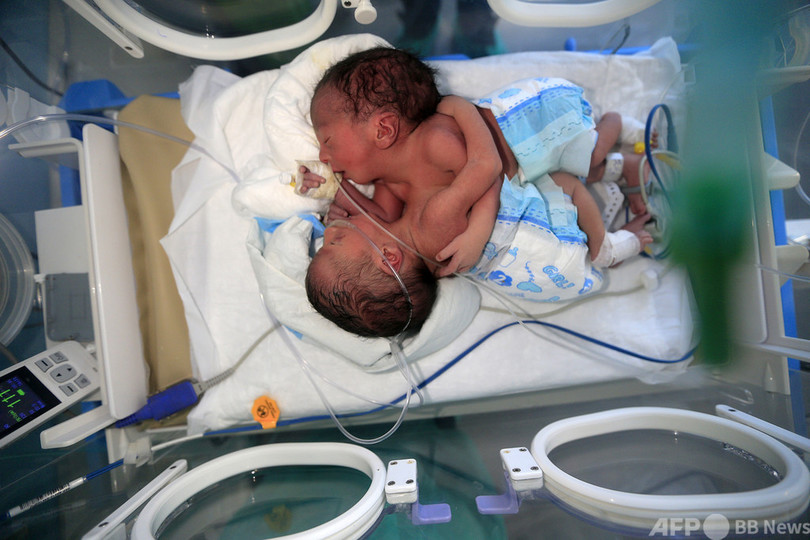 イエメンの結合双生児 分離手術のためヨルダンに移送 写真3枚 国際ニュース Afpbb News