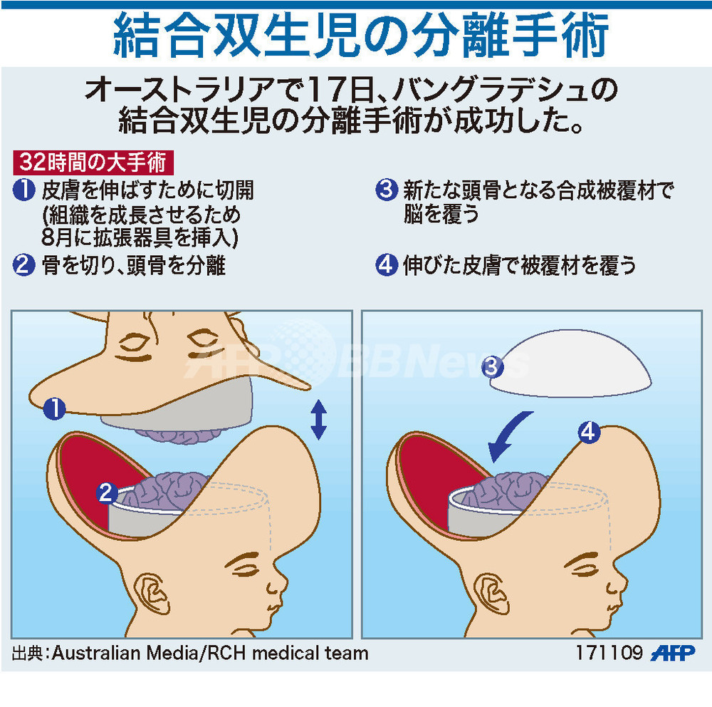 結合 双生児 分離 手術