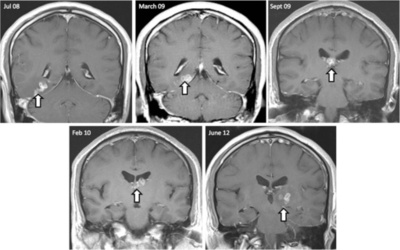 男性の脳内に4年間寄生、珍しい条虫を摘出