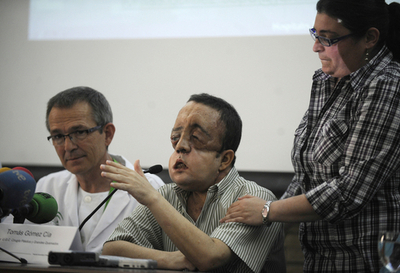 顔面移植の男性が会見、スペインで3例目