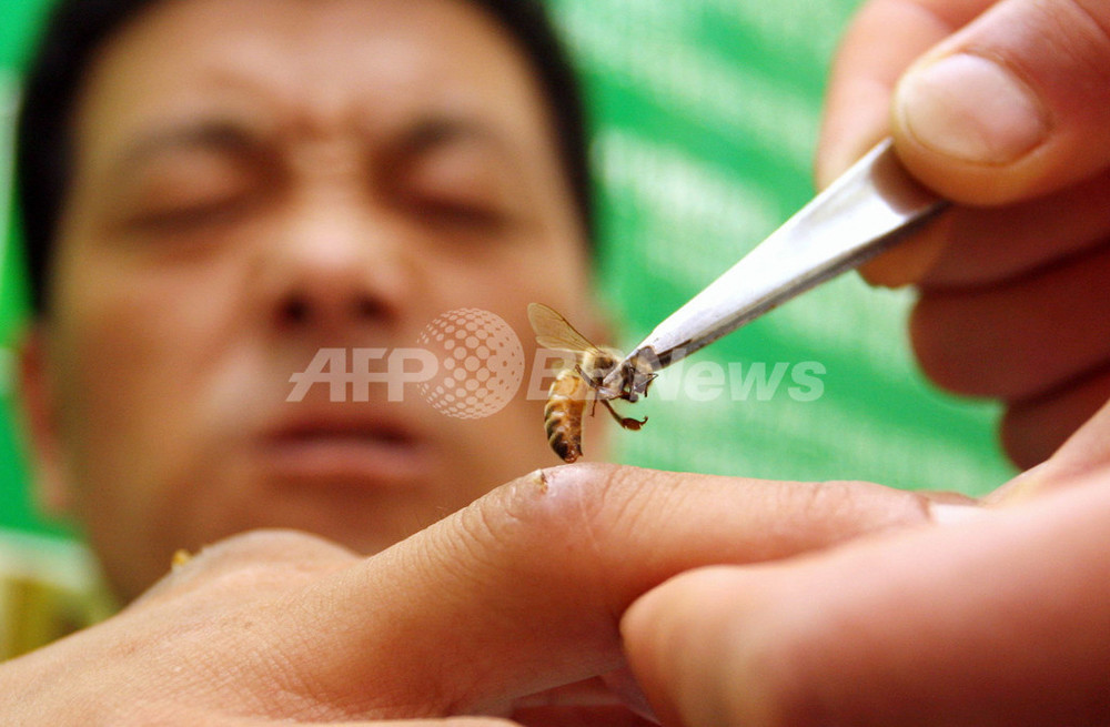 実証蜂針療法解説 ミツバチの毒で治療、中国3000年の歴史 写真3枚 国際ニュース：AFPBB News