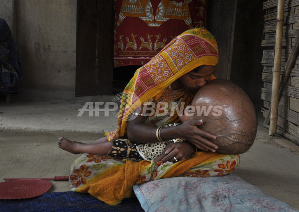 水頭症に苦しむインドの女児 治療に道は 国際ニュース Afpbb News