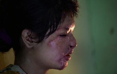 苦しみ続ける酸攻撃の被害女性たち、インド