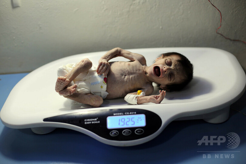シリア封鎖地域 子供1100人超が栄養失調 ユニセフ 写真5枚 国際ニュース Afpbb News