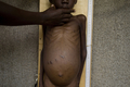 ウガンダ・カラモジャ（Karamoja）地方のマタニー（Matany）村の病院で診察を受ける栄養不良児。世界的な食糧価格の高騰は貧困国を直撃した（2008年4月9日撮影）。(c)AFP/Walter ASTRADA